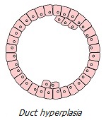 Hyperplasia