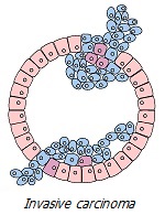 Invasive carcinoma