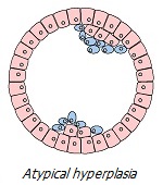 Metaplasia