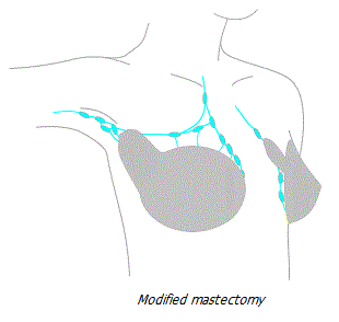 Modified mastectomy