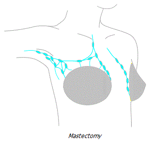 Mastectomy