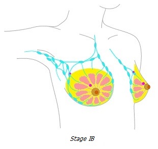 Breast cancer stage IB
