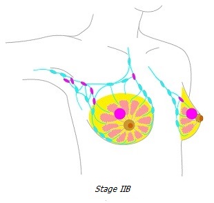 Breast cancer stage IIB