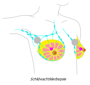 Schildwachtklierbiopsie