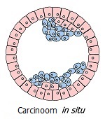 Carcinoom in situ