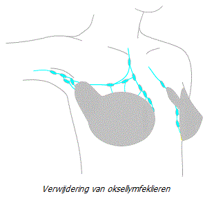 Gemodificeerde radicale chirurgie