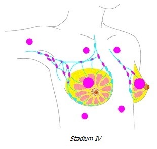 Stadium IV borstkanker
