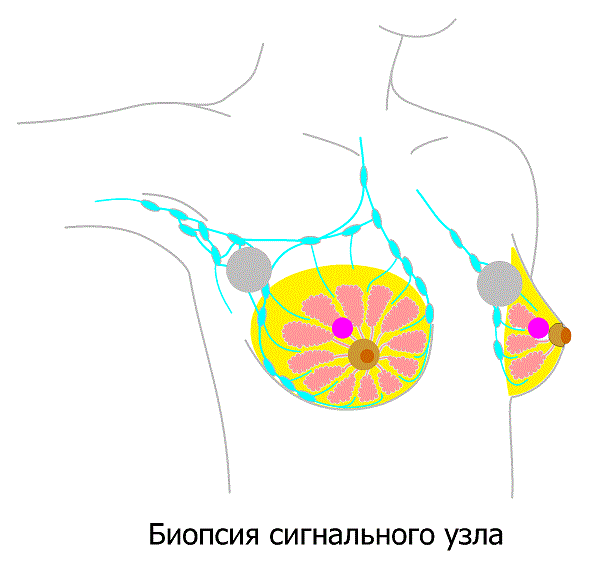 Изображение результата биопсии сигнального лимфоузла