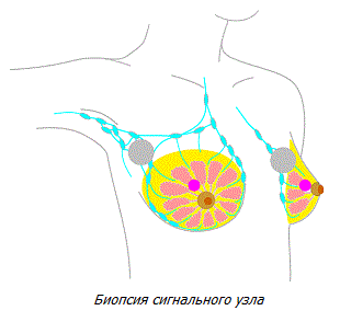 Биопсия сигнального лимфоузла