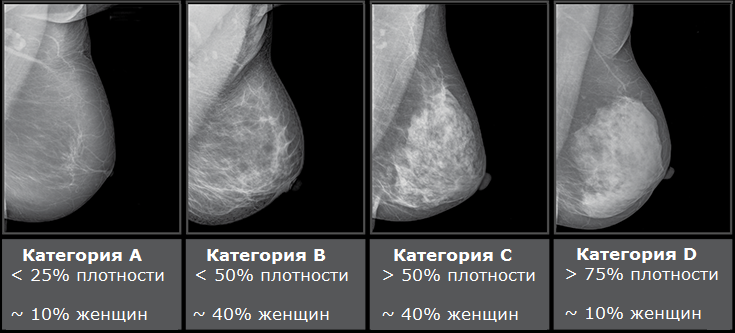 Маммографии груди с разной плотностью