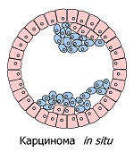 Карцинома