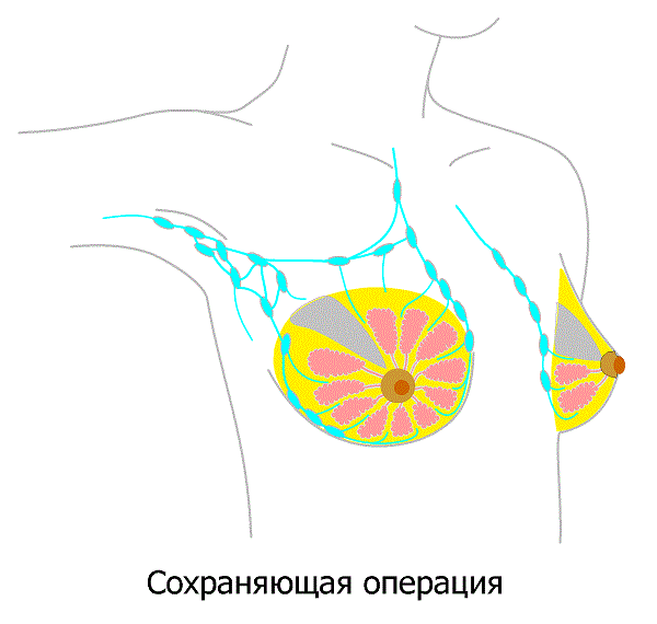 Органосохраняющая операция при раке груди
