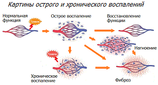 Воспаление - острое и хроническое