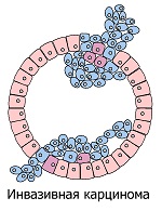 Инвазивная карцинома