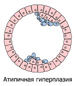 Метаплазия