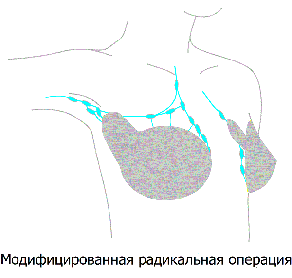 Результаты модифицированной радикальной мастэктомии