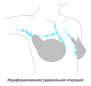 Модифицированная радикальная операция