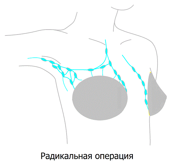 Результаты классической радикальной мастэктомии