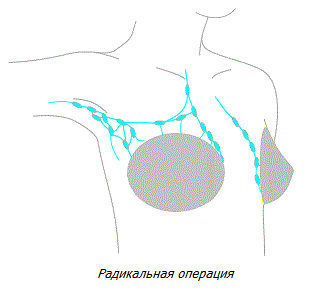 Радикальная операция