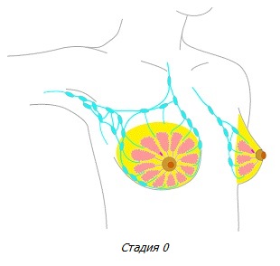 Рак молочной железы стадии 0