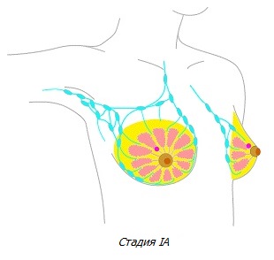Рак молочной железы стадии IA