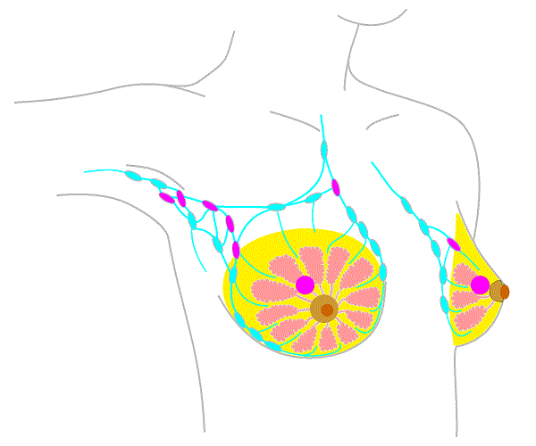 Стадия 2a рака груди