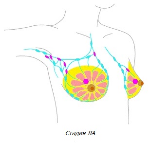 Рак молочной железы стадии IB