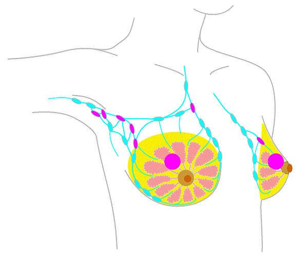 Стадия 2b рака груди