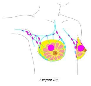 Рак молочной железы стадии IIIC