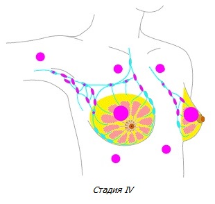 Рак молочной железы стадии IV
