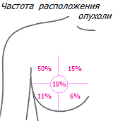 Распространённость местоположения опухоли